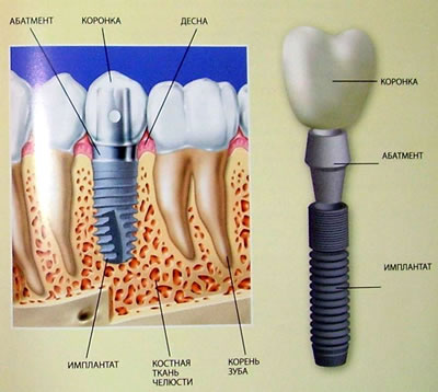 импланты зубов